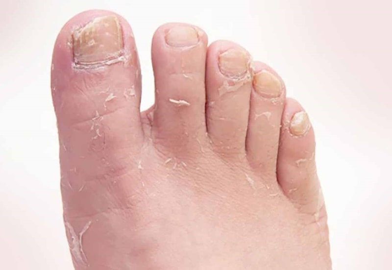 7 Sai Lầm Phổ Biến Khi Chọn Giày Dép Mùa Hè – Làm Sao Để Bảo Vệ Đôi Chân?